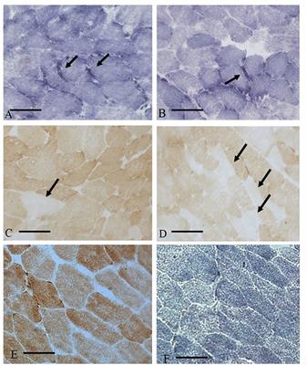 Risk of Myopathy in Patients in Therapy with Statins: Identification of Biological Markers in a Pilot Study